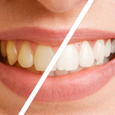 Vergleich von Zähnen einer jungen Frau vor und nach einer Zahnreinigung