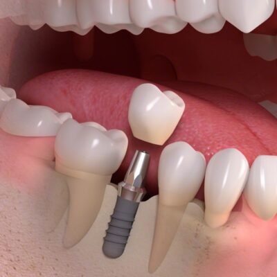 implant-borne_single-tooth_treatment_03